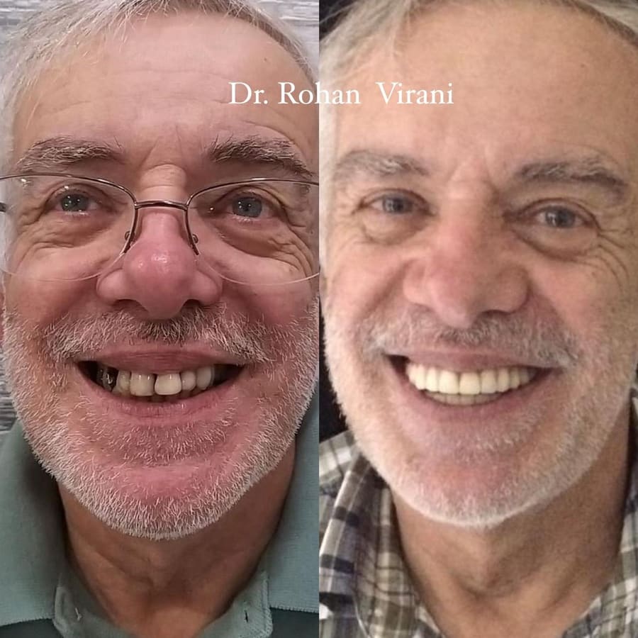Before and after smile result 4 at Trisa Dental Solutions