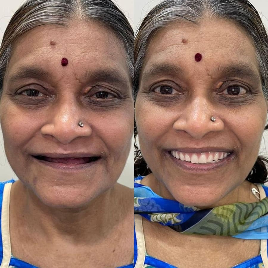 Before and after smile result 5 at Trisa Dental Solutions