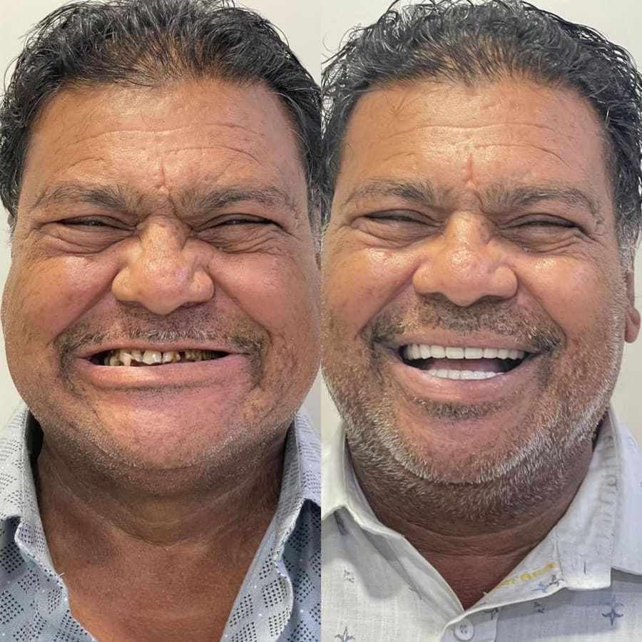 Before and after smile result 6 at Trisa Dental Solutions